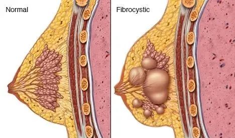 乳腺增生结节肿瘤摸起来什么区别看完不再纠结猜测了
